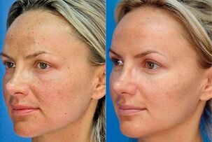 Φωτογραφία πριν και μετά την αναζωογόνηση του δέρματος με τη συσκευή